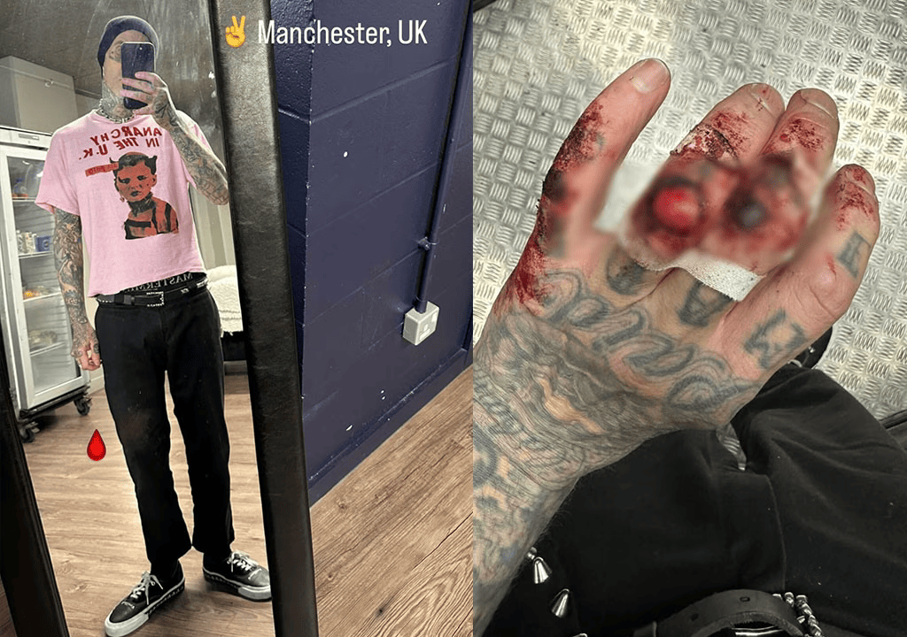 Travis Barker Shares Grisly Hand Injury Photo Post Blink-182 Concert in Manchester